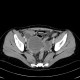 Endometriosis, ovarian endometriosis: CT - Computed tomography